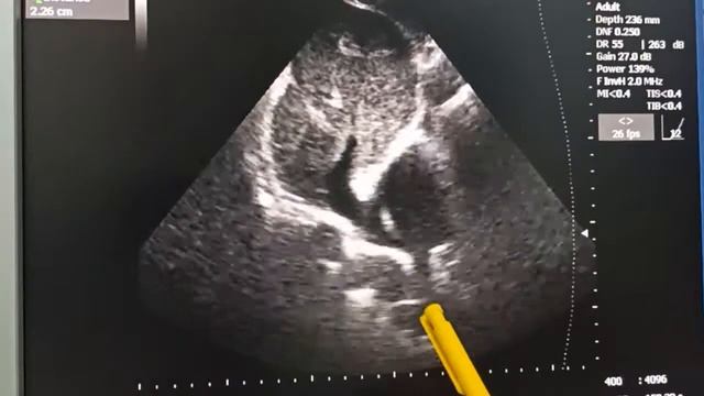 Дефект межжелудочковой перегородки, лазерные лучи смотреть онлайн