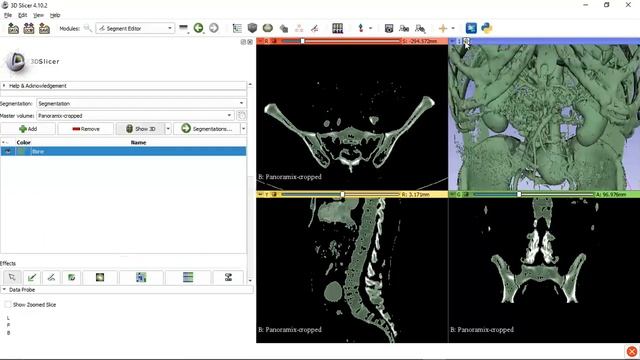 3D Slicer Tutorial(Bone Segmentation) смотреть онлайн