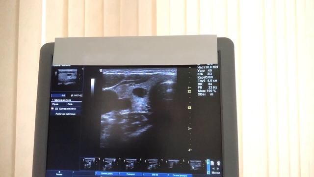 Узел или киста щитовидной железы? Различия и сходства. смотреть онлайн