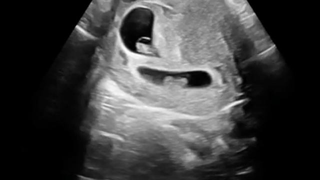 Узи двойня 9 недель