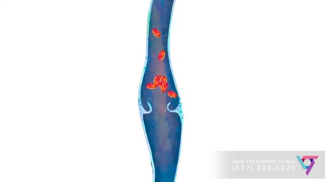 Medical Center: Laser Treatment for Varicose Veins | Spider and Varicose Vein Treatment Center смотреть онлайн