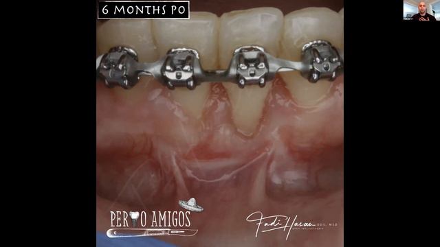 Soft Tissue Grafting Tips with the Perio Amigos смотреть онлайн