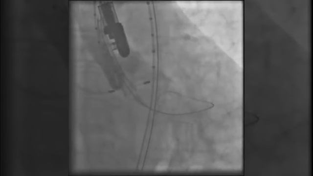 В область Ао клапана на доставочном устройстве заведе смотреть онлайн