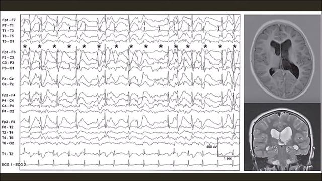 Артефакты на ЭЭГ. Часть 3