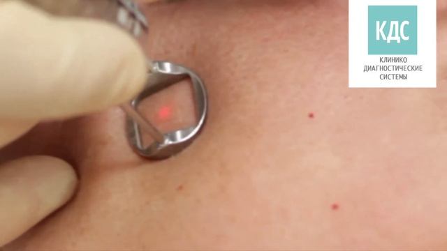 Фракционное омоложение кожи лазером FOTONA смотреть онлайн