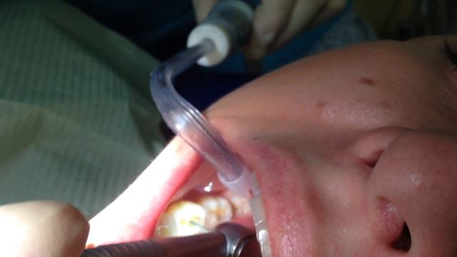 вторичный кариес, лечение (часть 1)