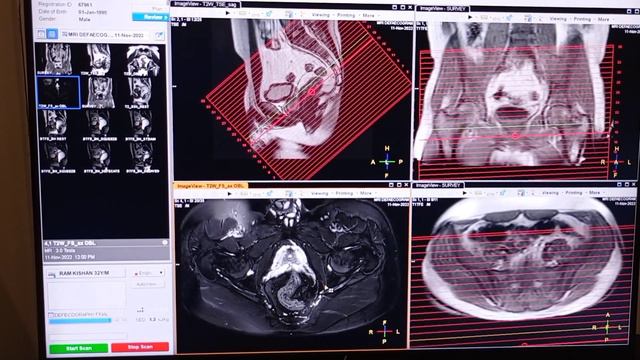 MRI Defecography patient position and preparation on Philips 3T смотреть онлайн