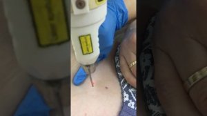 Лазерное удаление гемангиомы.