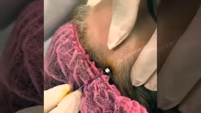 Подтяжка брови - Dr.Suleymanova смотреть онлайн