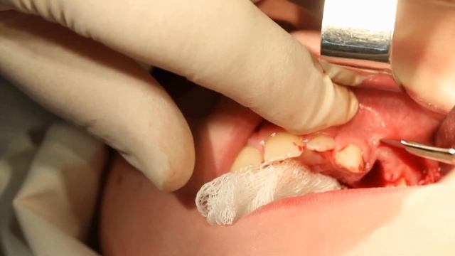 Периостотомия смотреть онлайн