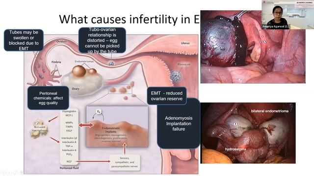 What is Polycystic ovarian syndrome (PCOS) & Endometriosis смотреть онлайн