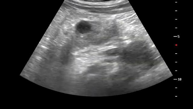 Лимфома почки. Renal lymphoma смотреть онлайн