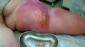 Вскрытие "пузыря" при рожистом воспалении