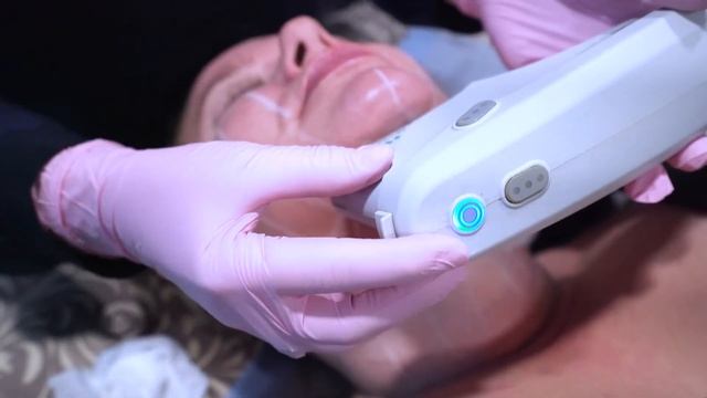 Ultherapy Neck Procedure and Facelift смотреть онлайн