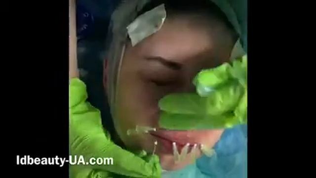 ?Тредлифтинг губ? смотреть онлайн