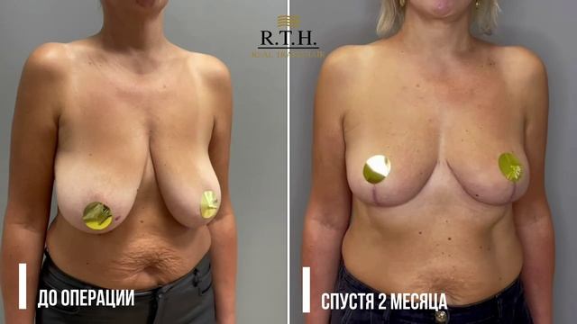 Подтяжка и уменьшение груди. Результат через 2 месяца.