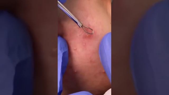 Можно ли давить прыщи ?#акне #прыщ #угри смотреть онлайн