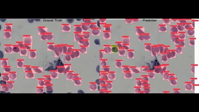 Malaria Detection with YOLOv5 and Faster R-CNN смотреть онлайн