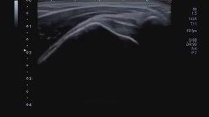 Сухожилие надостной мышцы