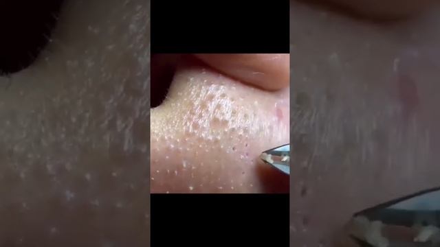 Прыщи Расширенные поры Как очистить кожу лица Почистить поры