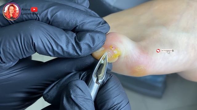 Бородавки?? / Стержневая мозоль / Бородавка / Wart