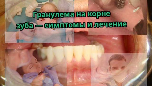 Гранулема на корне зуба — симптомы и лечение смотреть онлайн