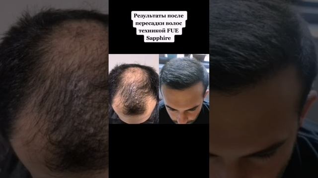 Пересадка волос в Турции | Результаты после пересадки волос