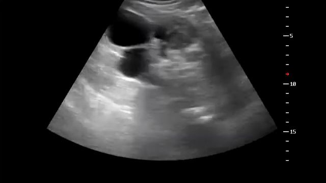 Кистозный рак почки. Cystic renal cell carcinoma смотреть онлайн