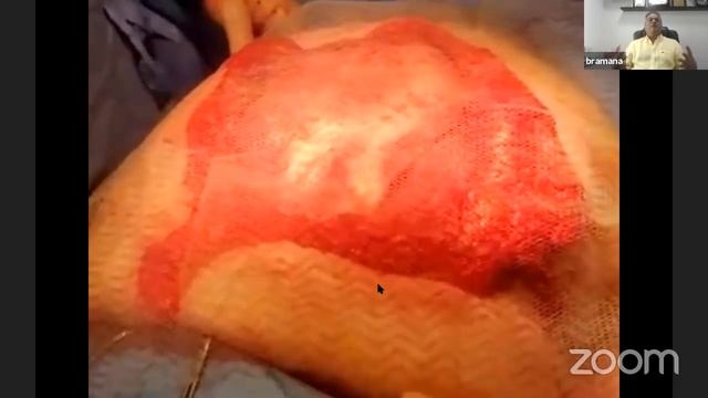 Open TAR surgical technique 101: marathon webcast (start at 5'') смотреть онлайн
