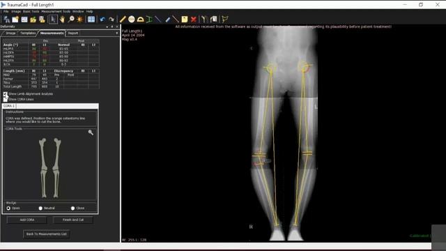 Getting started with TraumaCad Webinar смотреть онлайн