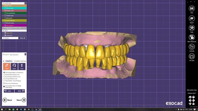 19. Тотальное моделирование на имплантатах с виртуальным артикулятором смотреть онлайн