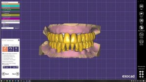 19. Тотальное моделирование на имплантатах с виртуальным артикулятором