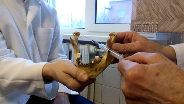 Торусальная анестезия