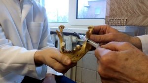 Торусальная анестезия