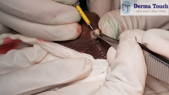 Excision of Scrotal Cysts No 34 अंडकोश पे दाने смотреть онлайн