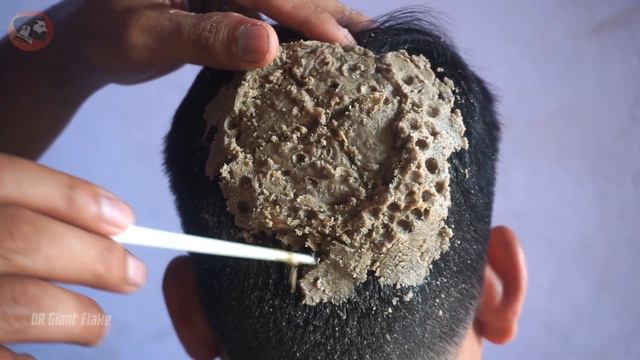 New Satisfying Update!! Dandruff Scratching #1131 смотреть онлайн