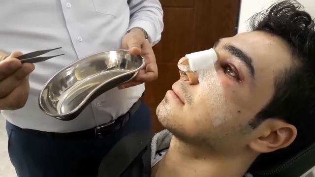 Removing nose mesh, 2 days after rhinoplasty surgery | خارج کردن مش بینی 2 روز بعد از عمل جراحی смотреть онлайн