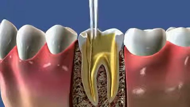 Лечение периодонтита внутриканальные штифты коронка смотреть онлайн