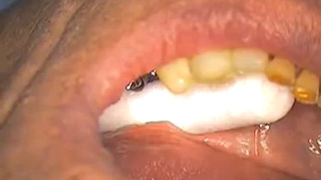 DR GERARD CUOMO - Branemark Dental Implant Broken Screw Case 5 of 7 - Boca Raton Florida смотреть онлайн