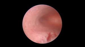 Нормальная полость матки