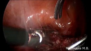 Эндометриоз мочевого пузыря, яичника, параметриев, прямой кишки