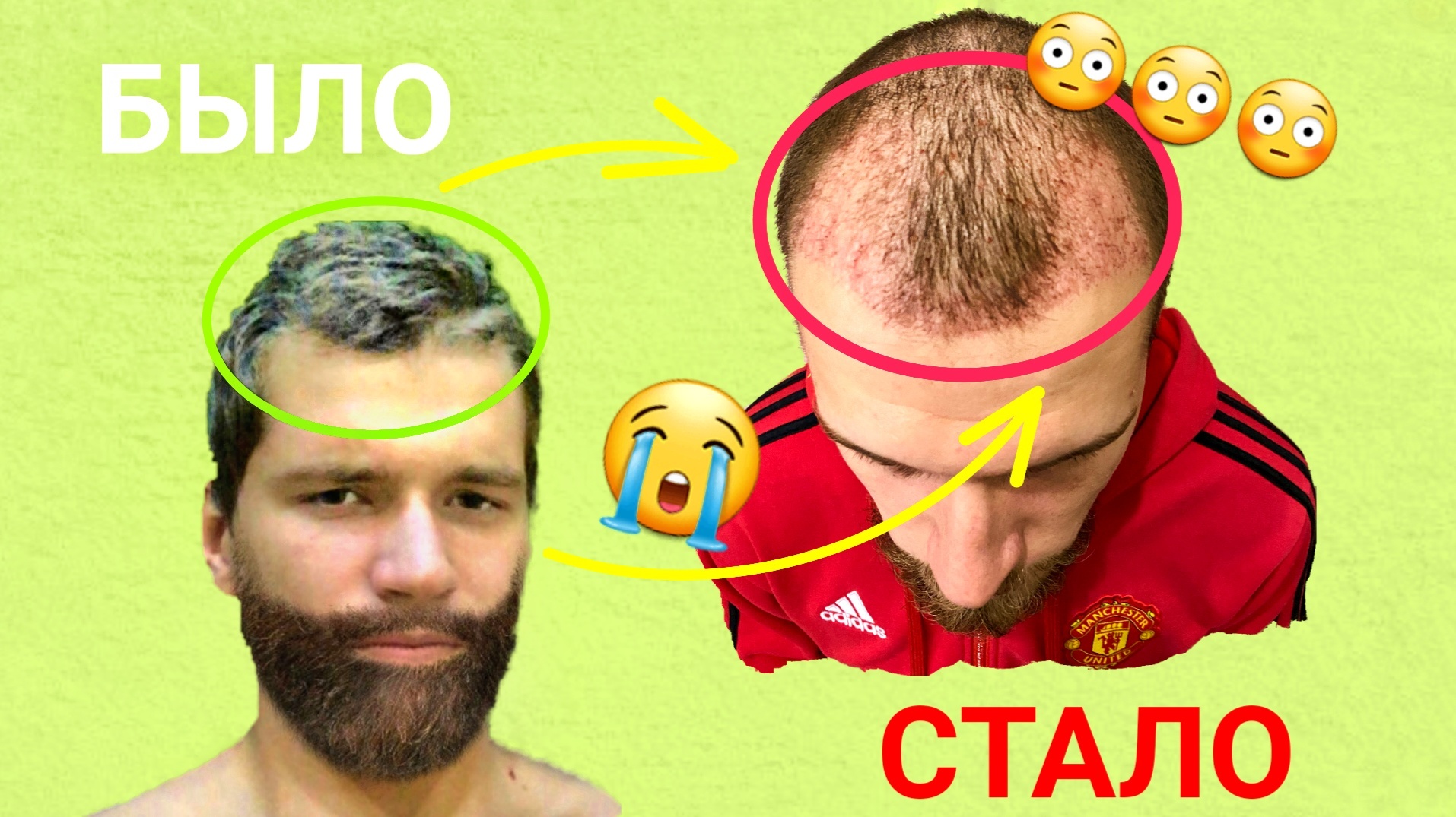 Пересадка волос в России. Блог #3 смотреть онлайн