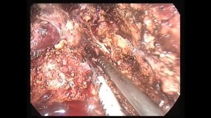 Лапароскопическая резекция 6, 7 сегментов печени по поводу большой гемангиомы