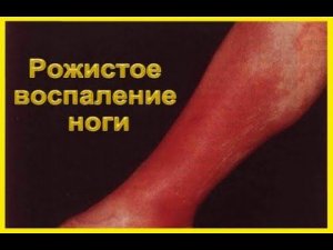 Лечение рожистого воспаления на ногах.