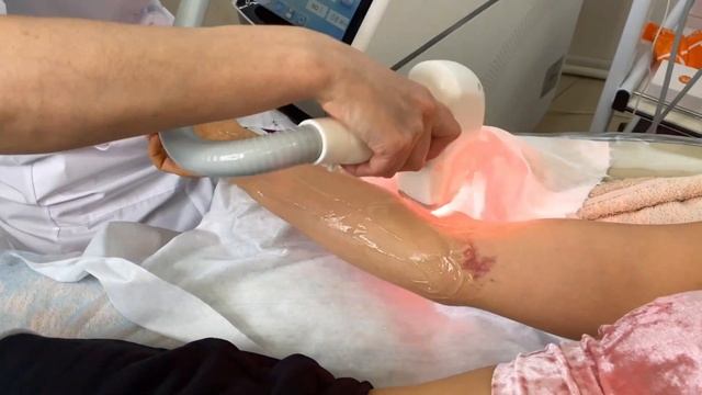 Лазерная эпиляция смотреть онлайн