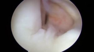 The Saber Technique for Biceps Tenotomy