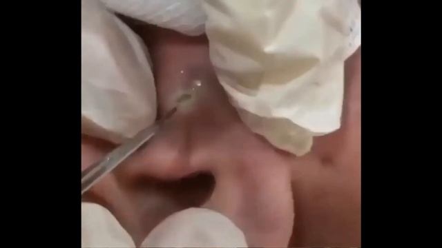 ОГРОМНЫЕ ПРЫЩИ В УШАХ!