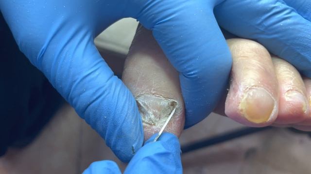 Nail Fungus Manicure For Ladies: Never Had A Pedicure【Pedicure Master Lin Jun】