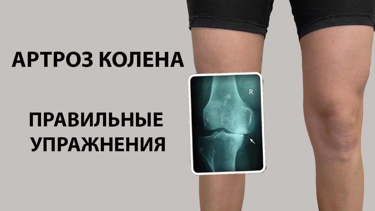 Гимнастика при артрозе коленного сустава. Упражнения для разработки и укрепления колена.