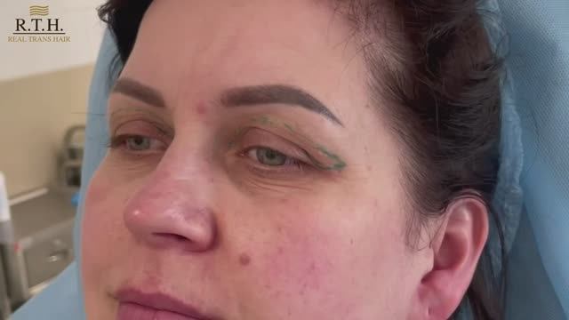 Трансконьюктивальная блефаропластика.